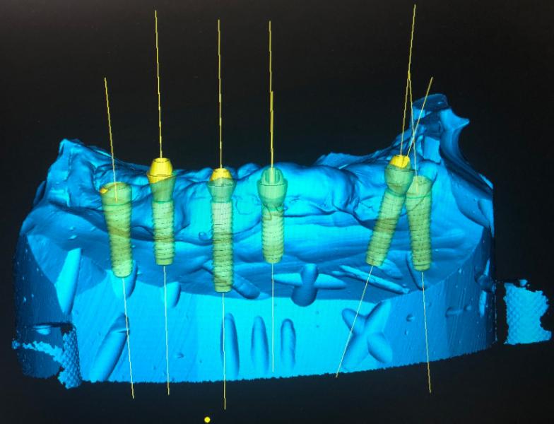 Planification implants - guides chirurgicaux