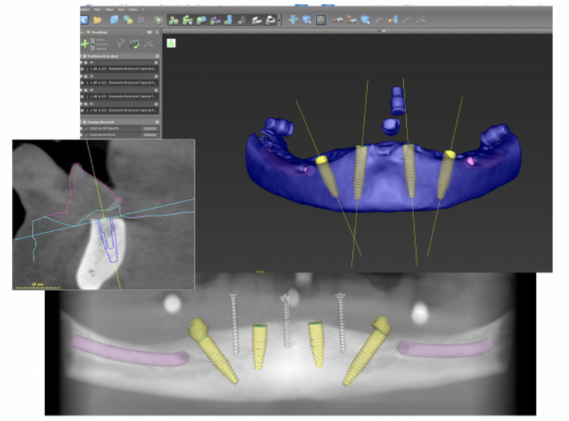 Guides chirurgicaux - logiciel diagnostix Straumann