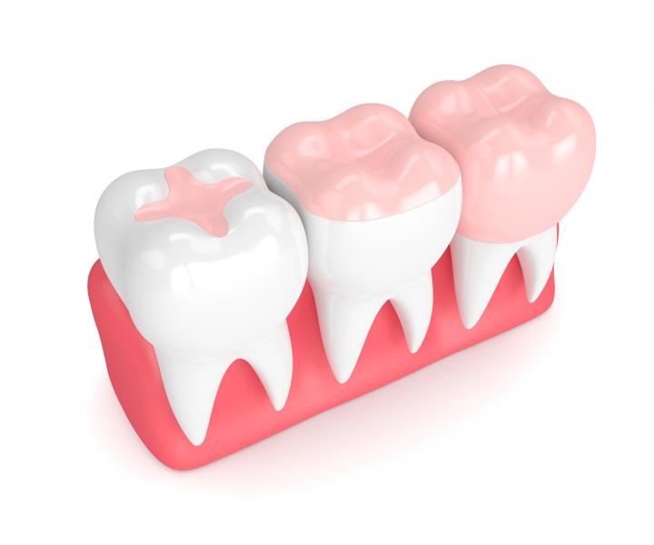 Reconstruction dentaire - Inlays Onlays