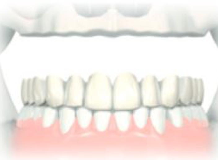 Prothèse amovible sur implants